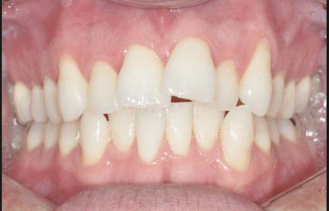deciduous teeth damage